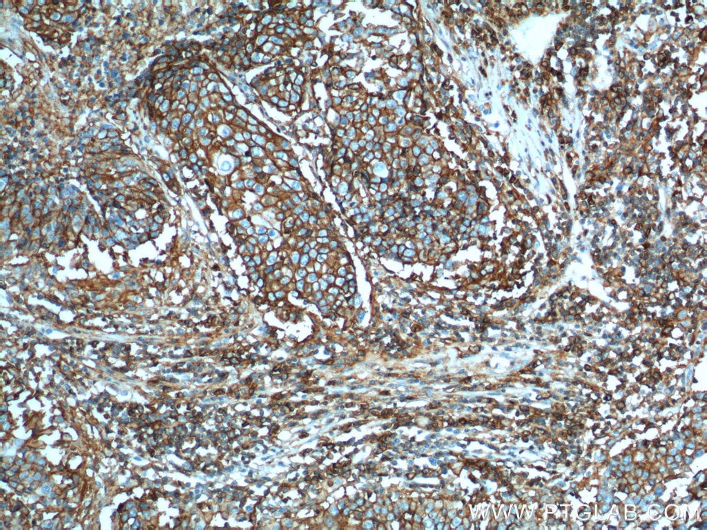 IHC staining of human lung cancer using 15675-1-AP
