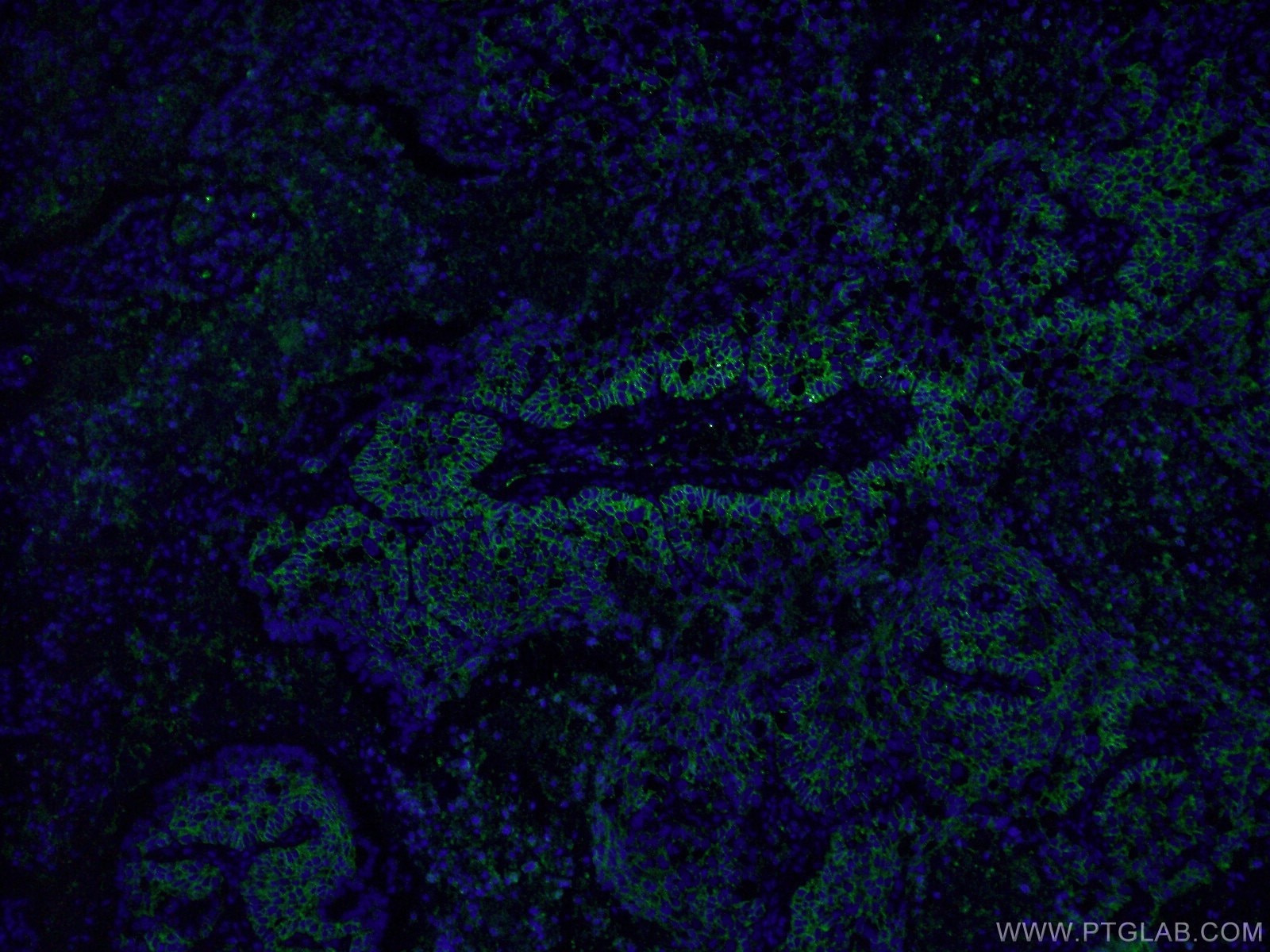 Immunofluorescence (IF) / fluorescent staining of human lung cancer tissue using CD44 Monoclonal antibody (60224-1-Ig)
