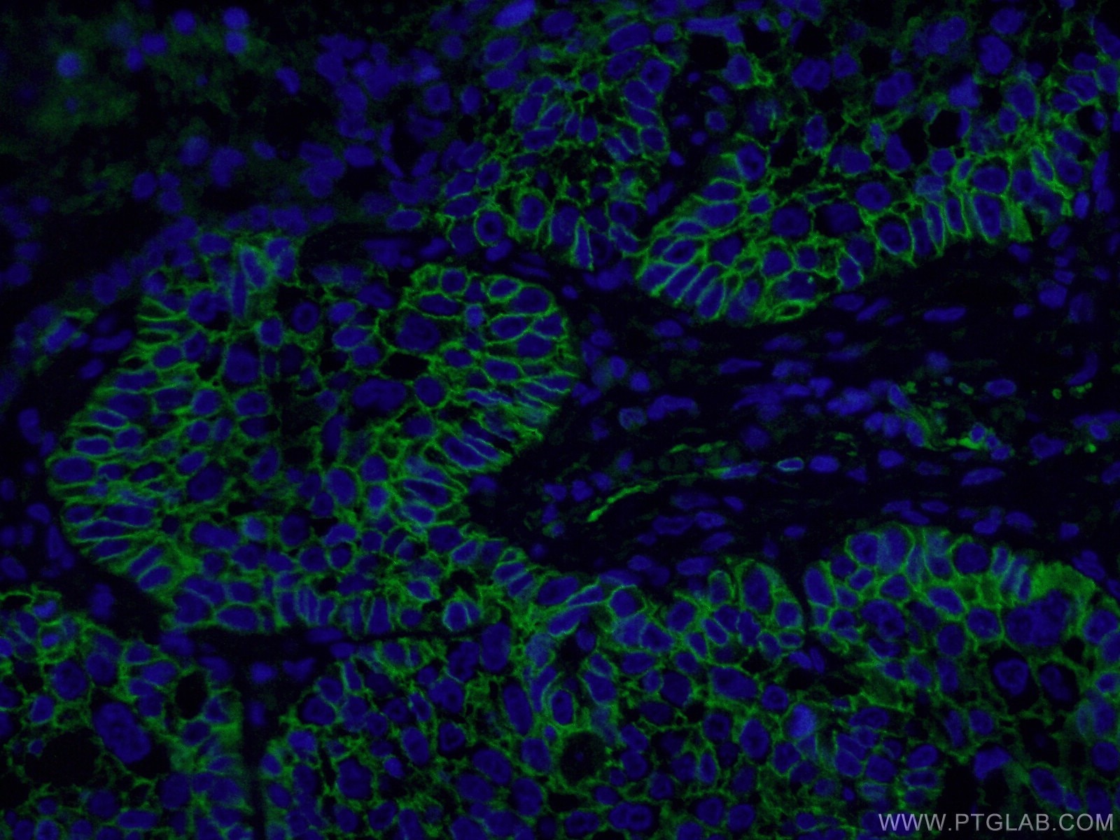 Immunofluorescence (IF) / fluorescent staining of human lung cancer tissue using CD44 Monoclonal antibody (60224-1-Ig)