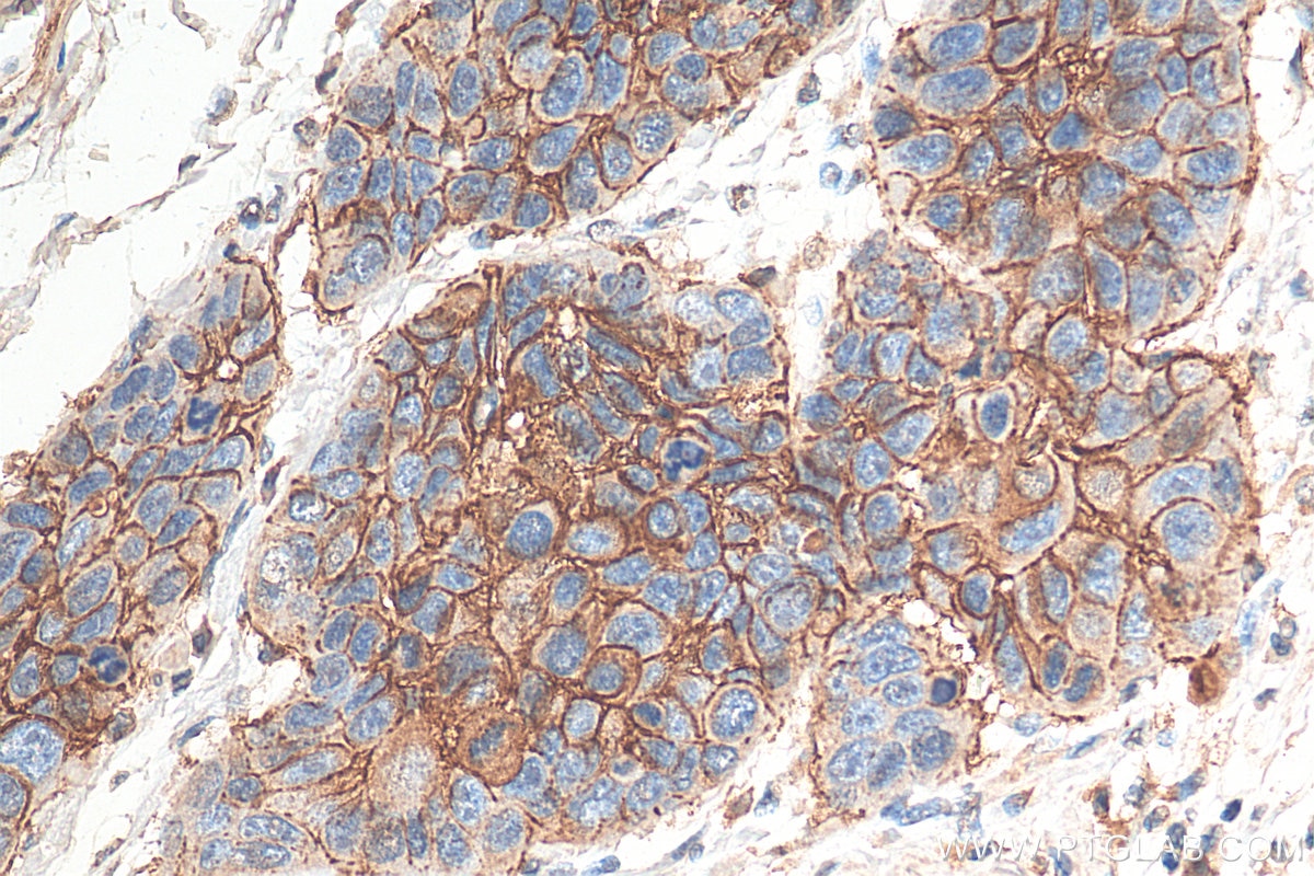 Immunohistochemistry (IHC) staining of human oesophagus cancer tissue using CD44 Monoclonal antibody (60224-1-Ig)