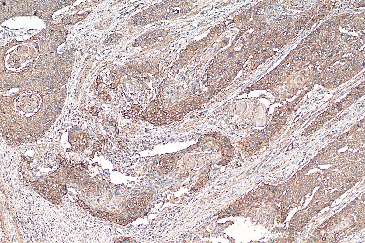 Immunohistochemistry (IHC) staining of human oesophagus cancer tissue using CD44 Monoclonal antibody (60224-1-Ig)