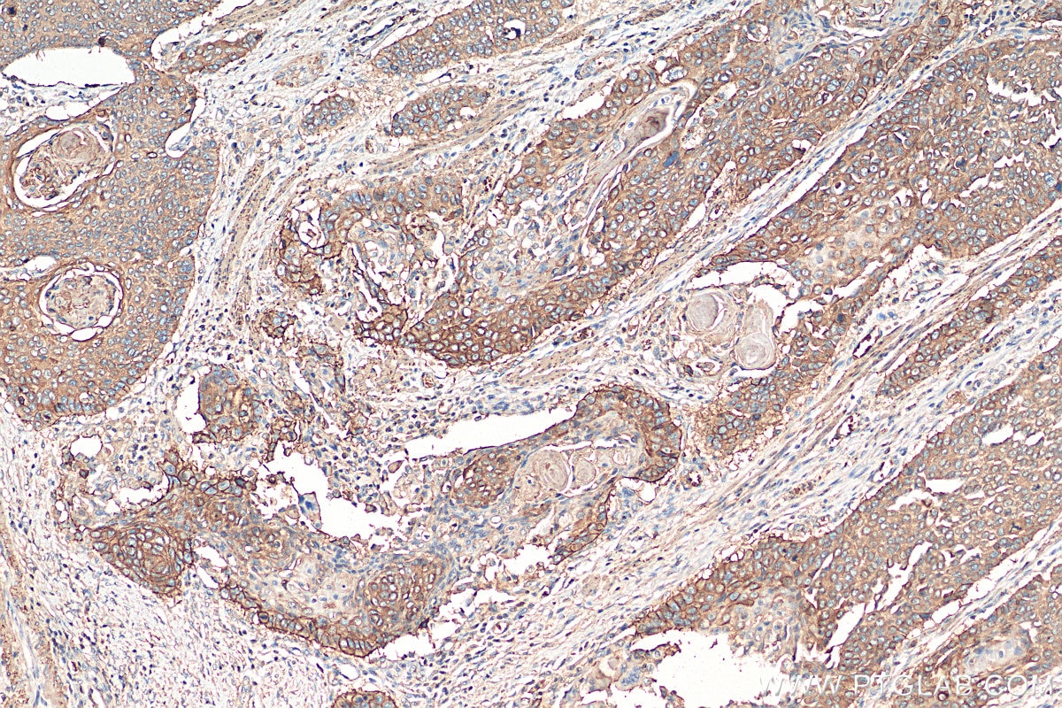 IHC staining of human oesophagus cancer using 60224-1-Ig