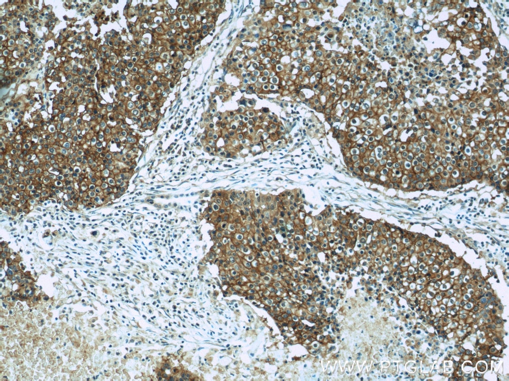 Immunohistochemistry (IHC) staining of human lung cancer tissue using CD44 Monoclonal antibody (60224-1-Ig)