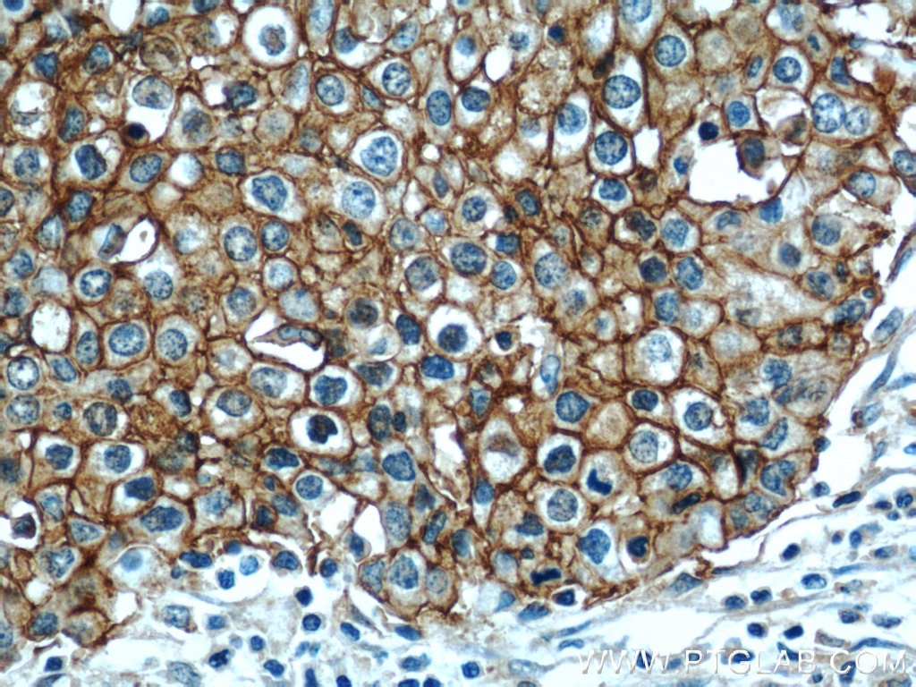 Immunohistochemistry (IHC) staining of human lung cancer tissue using CD44 Monoclonal antibody (60224-1-Ig)