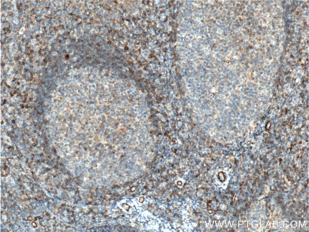Immunohistochemistry (IHC) staining of human tonsillitis tissue using CD44 Monoclonal antibody (60224-1-Ig)