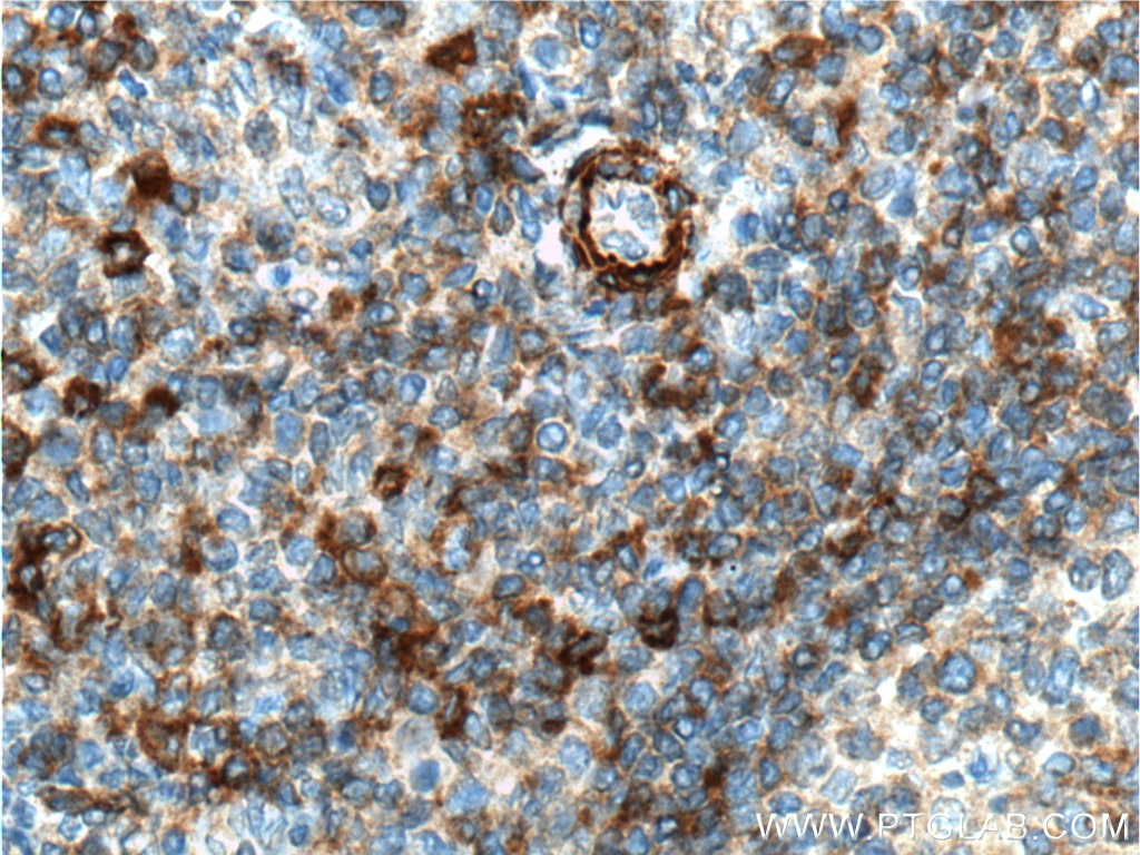 Immunohistochemistry (IHC) staining of human tonsillitis tissue using CD44 Monoclonal antibody (60224-1-Ig)