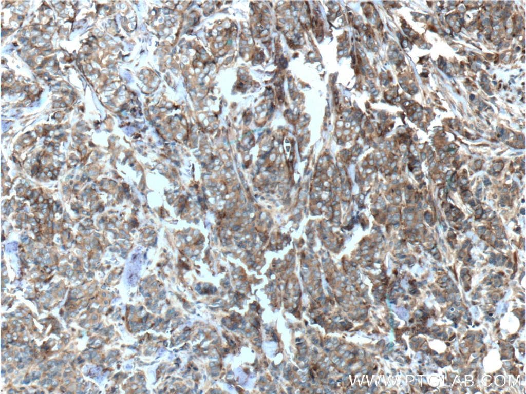 Immunohistochemistry (IHC) staining of human breast cancer tissue using CD44 Monoclonal antibody (60224-1-Ig)