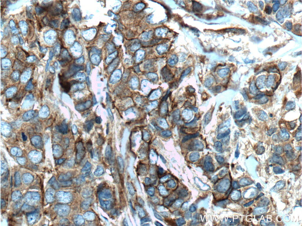 Immunohistochemistry (IHC) staining of human breast cancer tissue using CD44 Monoclonal antibody (60224-1-Ig)