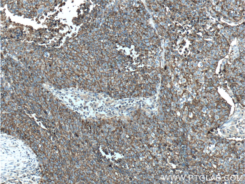 Immunohistochemistry (IHC) staining of human lung cancer tissue using CD44 Monoclonal antibody (60224-1-Ig)