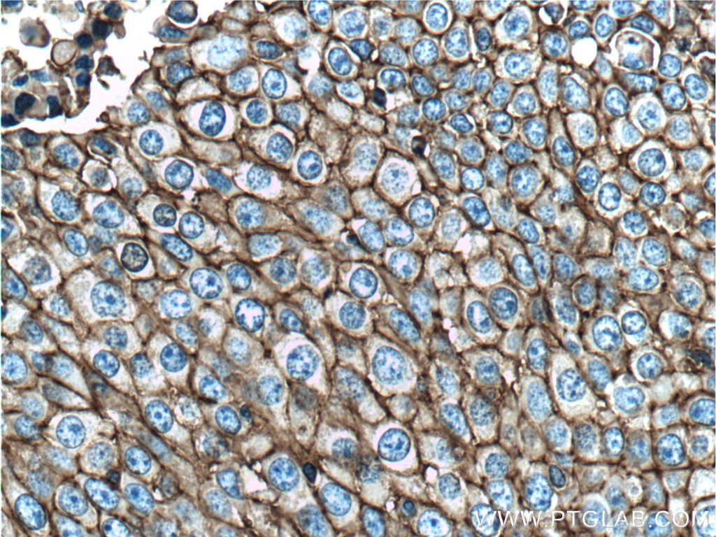 IHC staining of human lung cancer using 60224-1-Ig