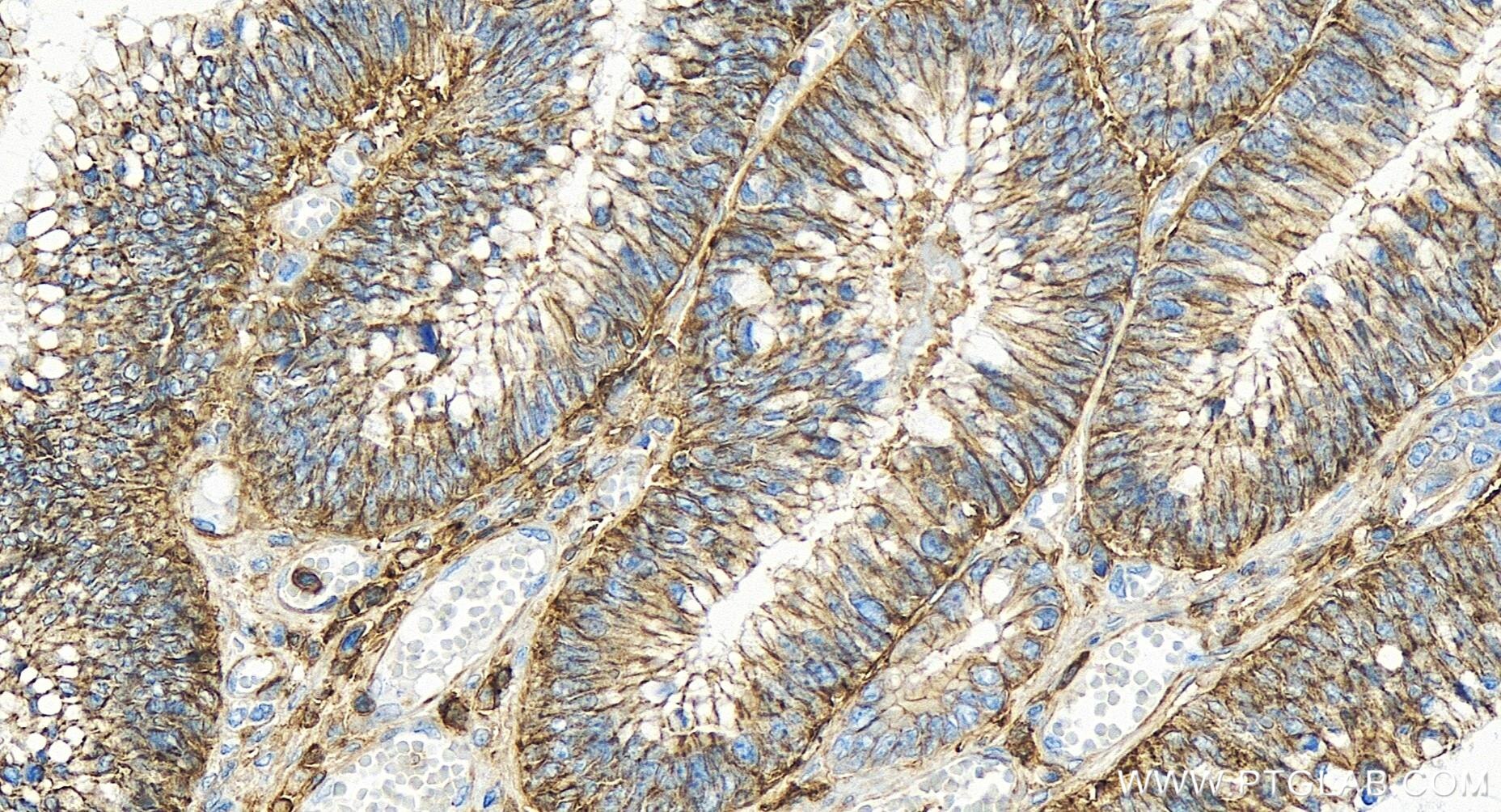 Immunohistochemistry (IHC) staining of human colon cancer tissue using CD44 Recombinant antibody (84854-5-RR)