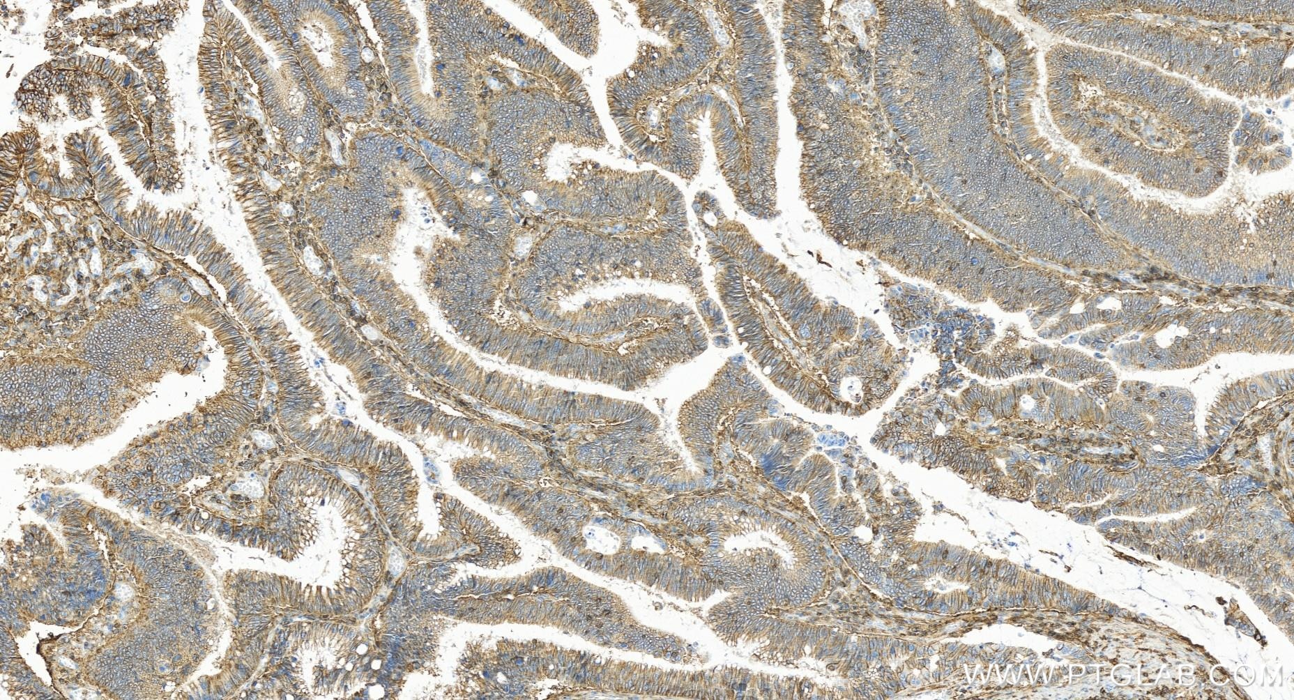 Immunohistochemistry (IHC) staining of human colon cancer tissue using CD44 Recombinant antibody (84854-5-RR)