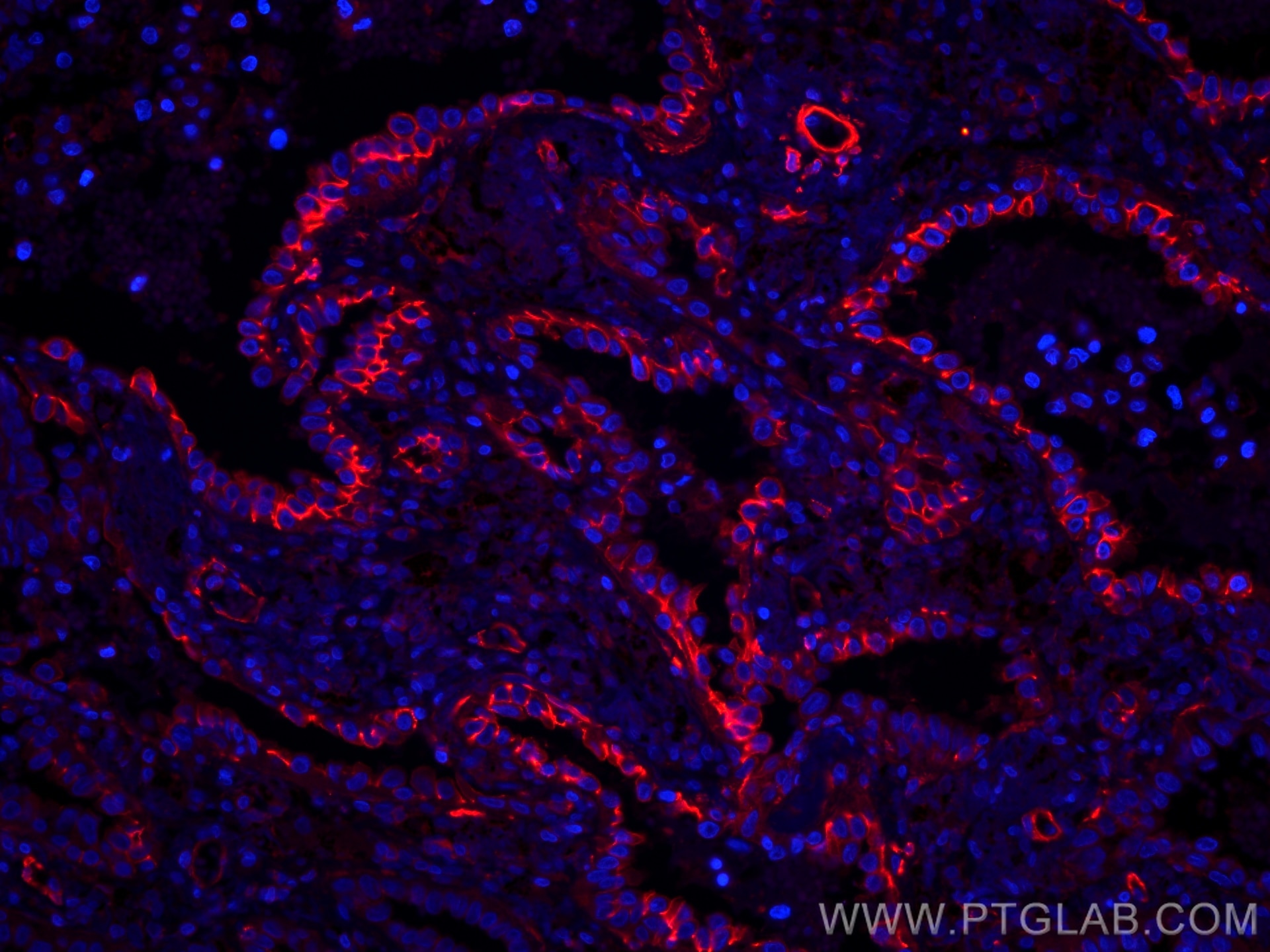 Immunofluorescence (IF) / fluorescent staining of human lung cancer tissue using CoraLite®594-conjugated CD44 Monoclonal antibody (CL594-60224)