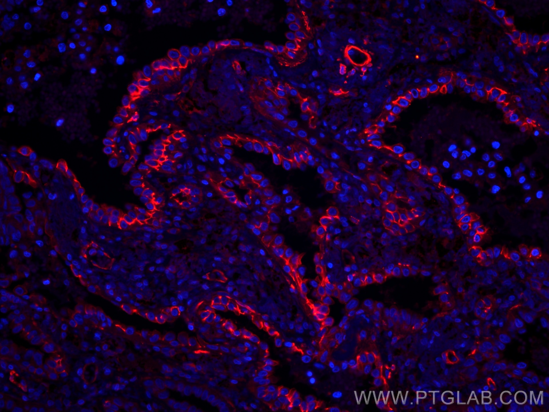 IF Staining of human lung cancer using CL594-60224