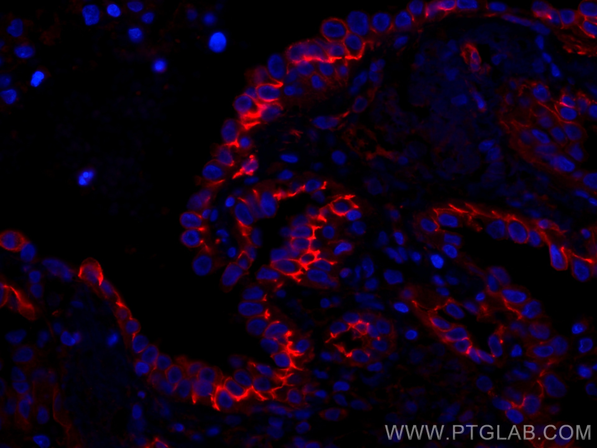 Immunofluorescence (IF) / fluorescent staining of human lung cancer tissue using CoraLite®594-conjugated CD44 Monoclonal antibody (CL594-60224)