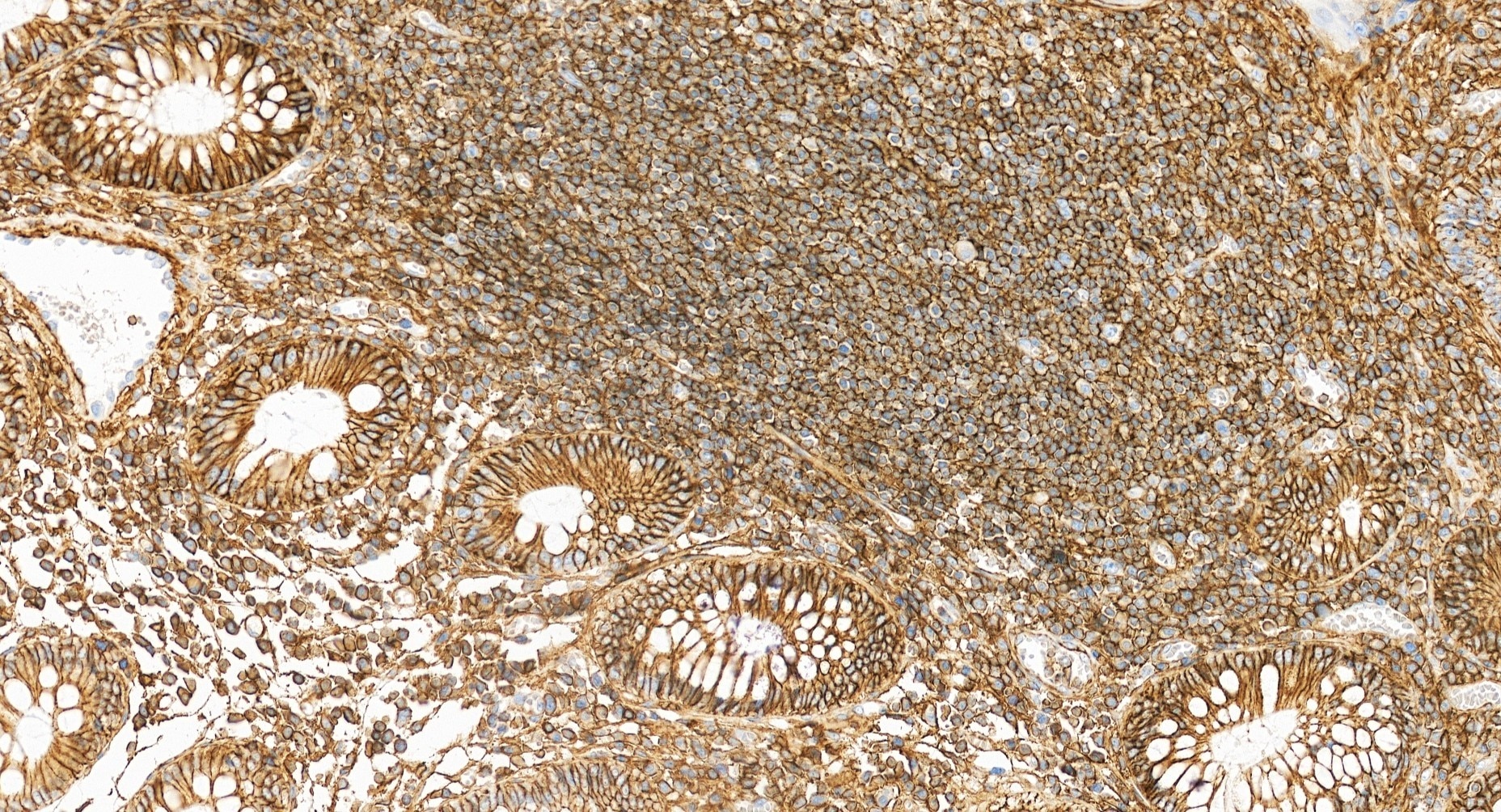 Immunohistochemistry (IHC) staining of human colon cancer tissue using Multi-rAb® CD44 Multi-Recombinant antibody (RMX00065)
