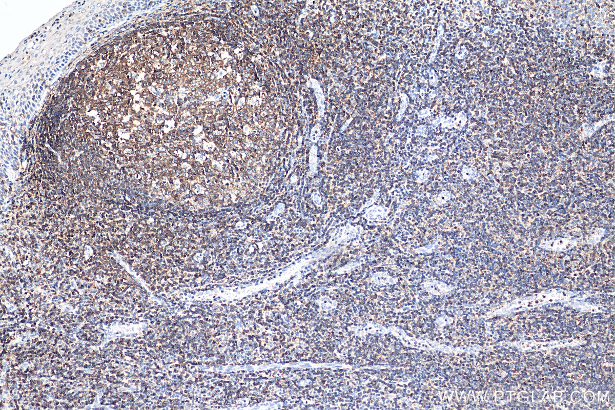 Immunohistochemistry (IHC) staining of human tonsillitis tissue using CD45 Polyclonal antibody (29914-1-AP)