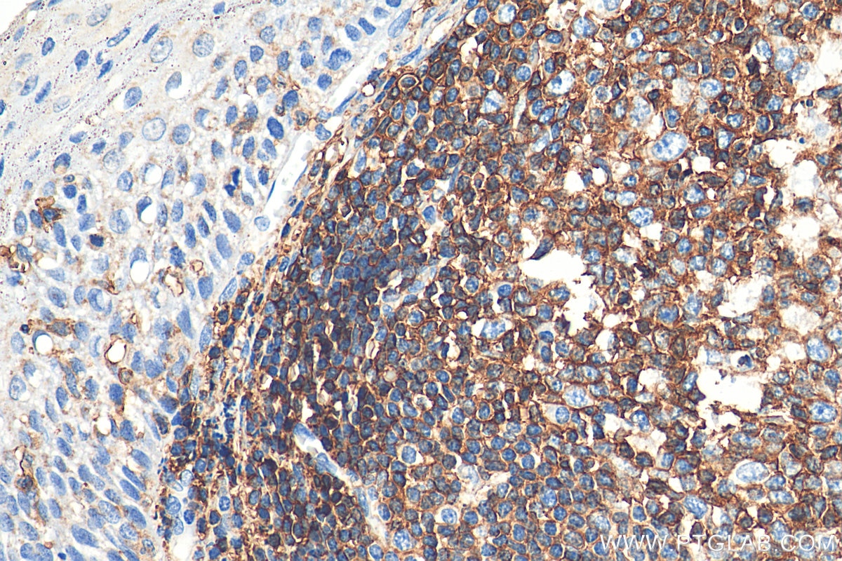 Immunohistochemistry (IHC) staining of human tonsillitis tissue using CD45 Polyclonal antibody (29914-1-AP)