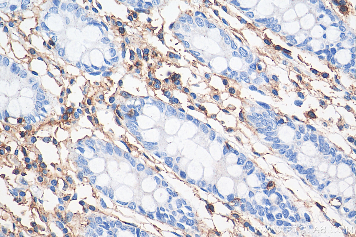 Immunohistochemistry (IHC) staining of human colon tissue using CD45 Polyclonal antibody (29914-1-AP)