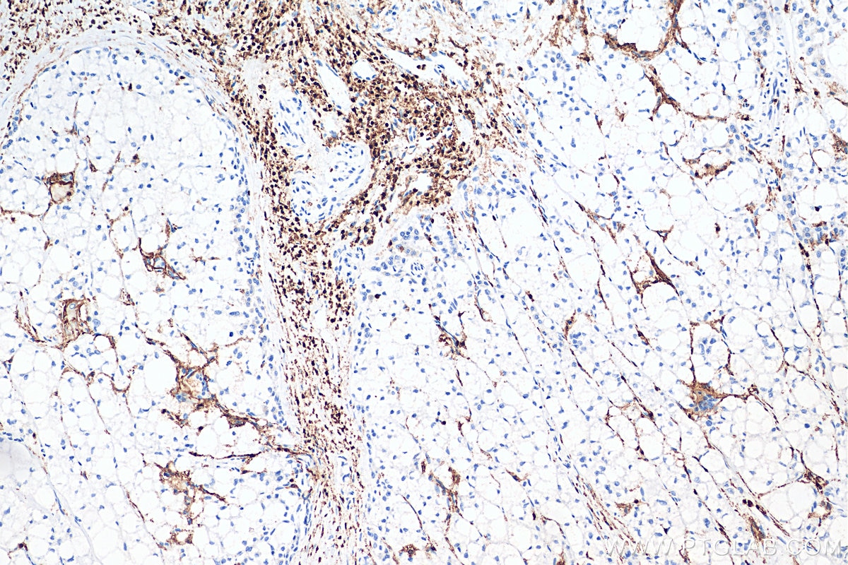 Immunohistochemistry (IHC) staining of human liver cancer tissue using CD45 Polyclonal antibody (29914-1-AP)