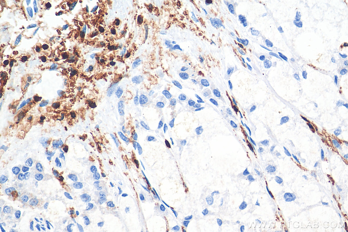 Immunohistochemistry (IHC) staining of human liver cancer tissue using CD45 Polyclonal antibody (29914-1-AP)