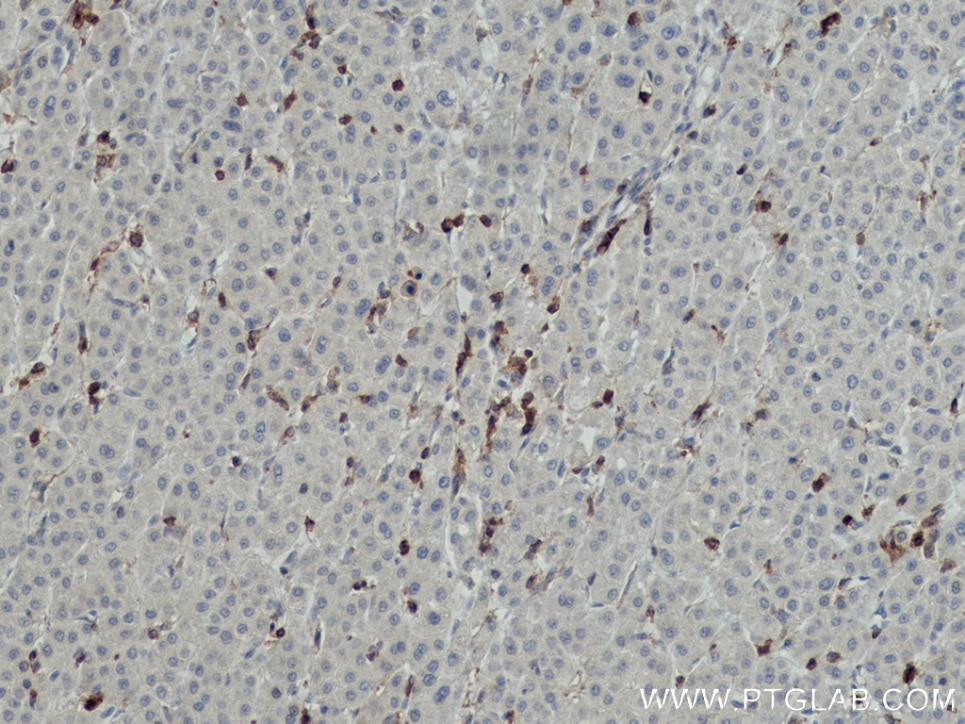 Immunohistochemistry (IHC) staining of human liver cancer tissue using CD45 Monoclonal antibody (60287-1-Ig)