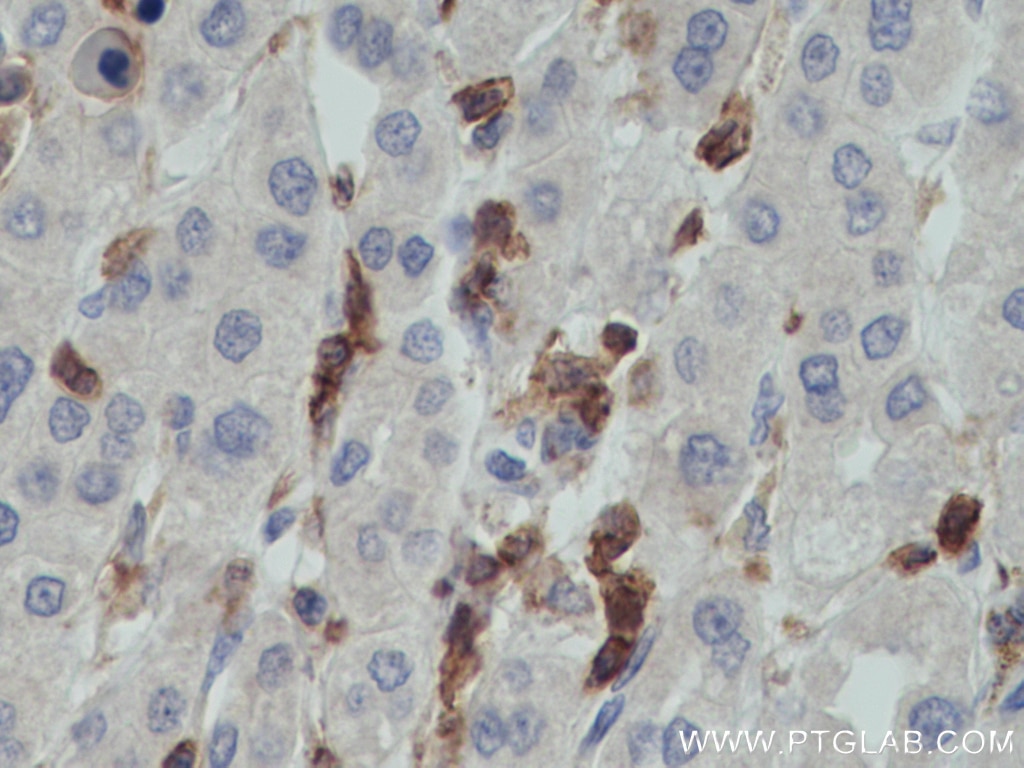 Immunohistochemistry (IHC) staining of human liver cancer tissue using CD45 Monoclonal antibody (60287-1-Ig)