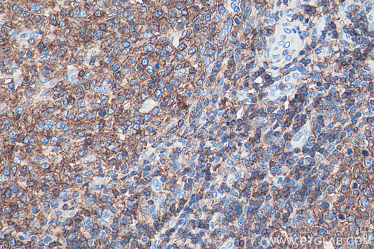 Immunohistochemistry (IHC) staining of human tonsillitis tissue using CD45 Monoclonal antibody (60287-1-Ig)