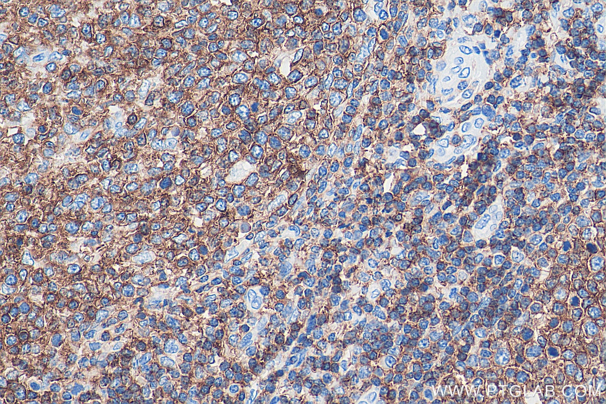 IHC staining of human tonsillitis using 60287-1-Ig