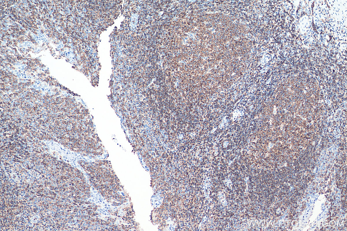 IHC staining of human tonsillitis using 60287-1-Ig