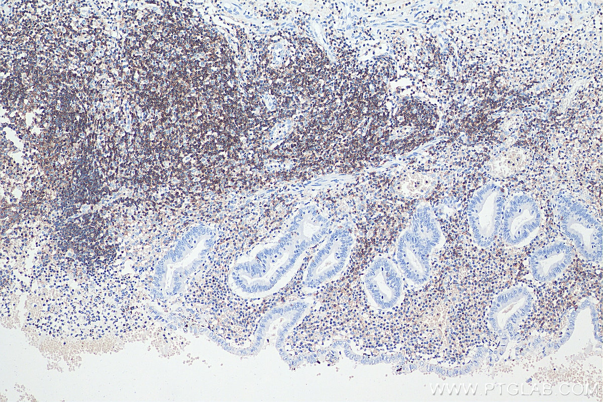 Immunohistochemistry (IHC) staining of human appendicitis tissue using CD45 Monoclonal antibody (60287-1-Ig)