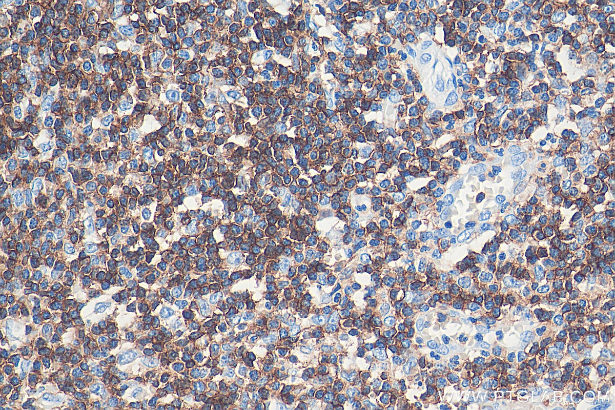 Immunohistochemistry (IHC) staining of human appendicitis tissue using CD45 Monoclonal antibody (60287-1-Ig)