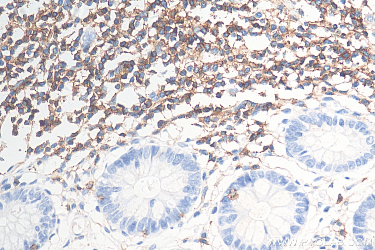 Immunohistochemistry (IHC) staining of human colon tissue using CD45 Monoclonal antibody (60287-1-Ig)