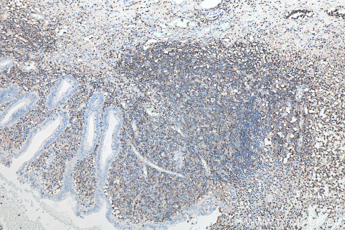 Immunohistochemistry (IHC) staining of human appendicitis tissue using CD45 Recombinant antibody (80297-1-RR)