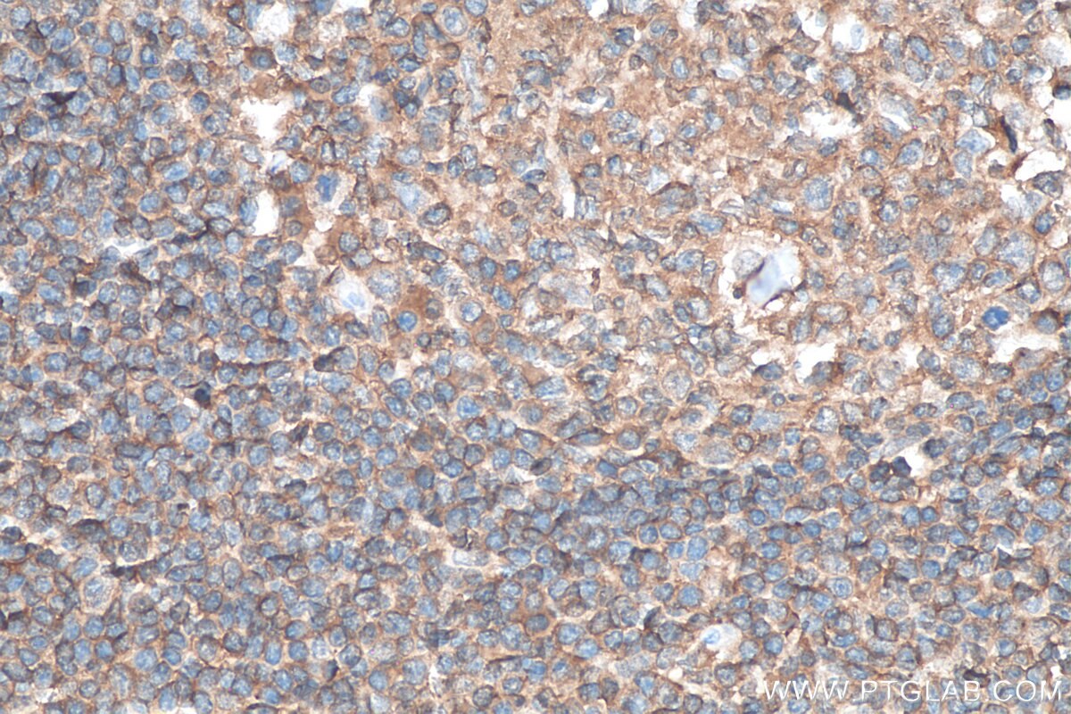 Immunohistochemistry (IHC) staining of human tonsillitis tissue using CD45 Recombinant antibody (80297-1-RR)