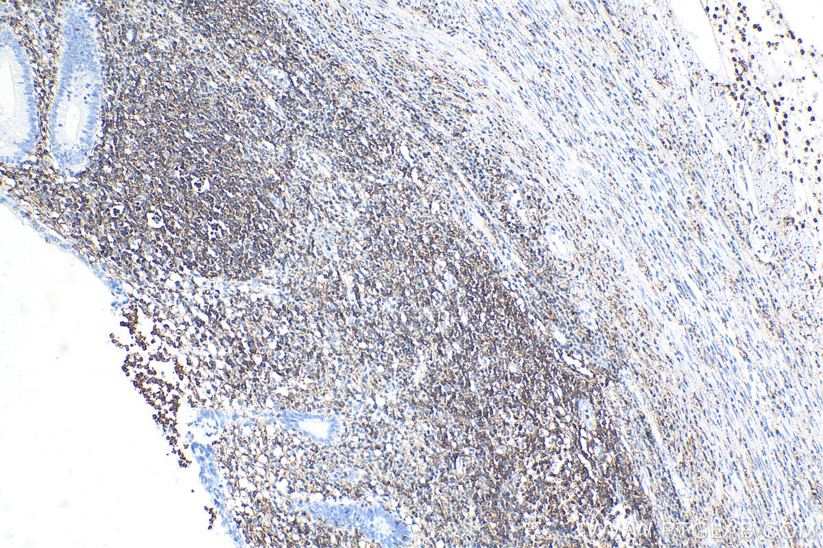 Immunohistochemistry (IHC) staining of human appendicitis tissue using CD45 Recombinant antibody (80297-1-RR)