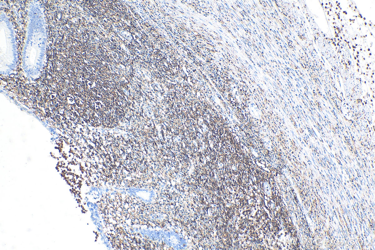 IHC staining of human appendicitis using 80297-1-RR