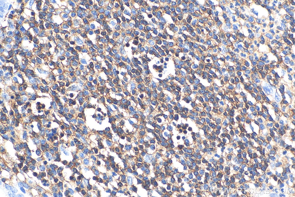 Immunohistochemistry (IHC) staining of human appendicitis tissue using CD45 Recombinant antibody (80297-1-RR)