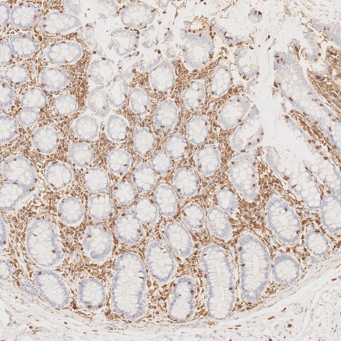 IHC staining of human colorectal cancer using 80297-1-RR Immunohistochemistry (IHC) staining of human colorectal cancer tissue using CD45 Recombinant monoclonal antibody (80297-1-RR)