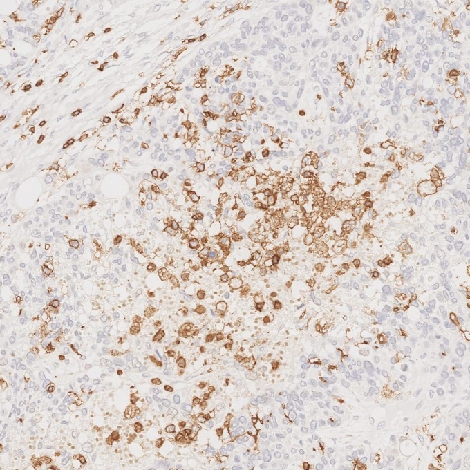 IHC staining of human ovary cancer using 80297-1-RR Immunohistochemistry (IHC) staining of human ovary cancer tissue using CD45 Recombinant monoclonal antibody (80297-1-RR)