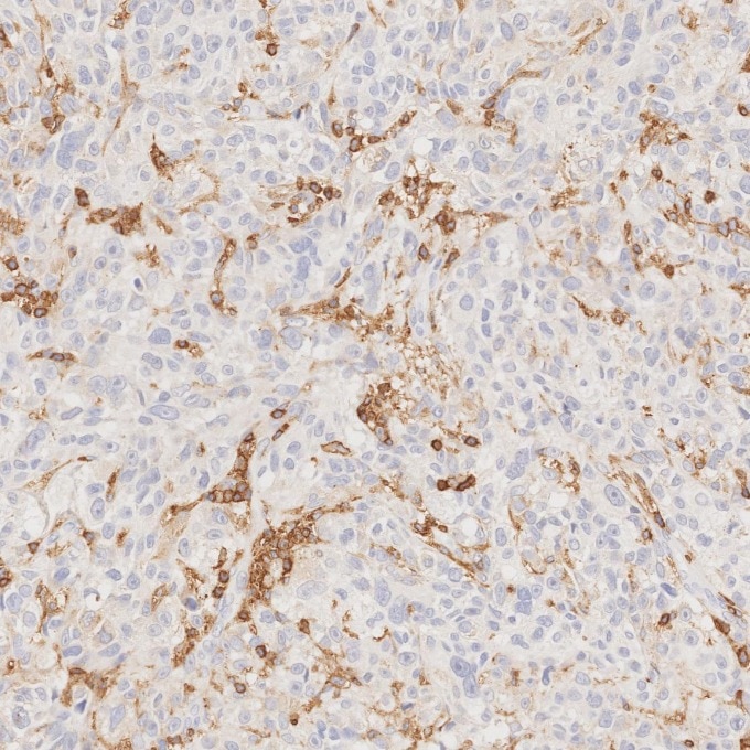 IHC staining of human malignant melanoma using 80297-1-RR Immunohistochemistry (IHC) staining of human malignant melanoma tissue using CD45 Recombinant monoclonal antibody (80297-1-RR)