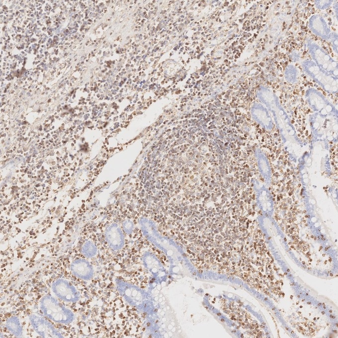 IHC staining of human lymphoma using 80297-1-RR Immunohistochemistry (IHC) staining of human lymphoma tissue using CD45 Recombinant monoclonal antibody (80297-1-RR)