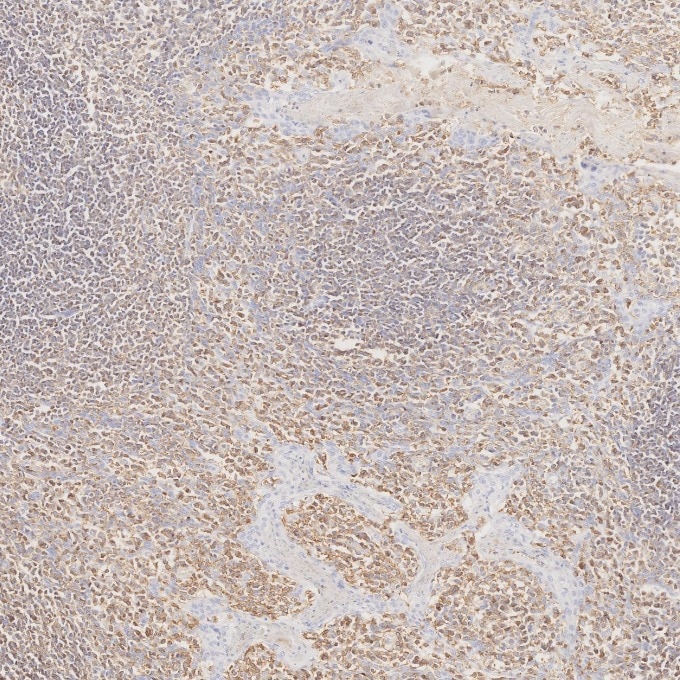 IHC staining of human tonsillitis using 80297-1-RR Immunohistochemistry (IHC) staining of human tonsillitis tissue using CD45 Recombinant monoclonal antibody (80297-1-RR)