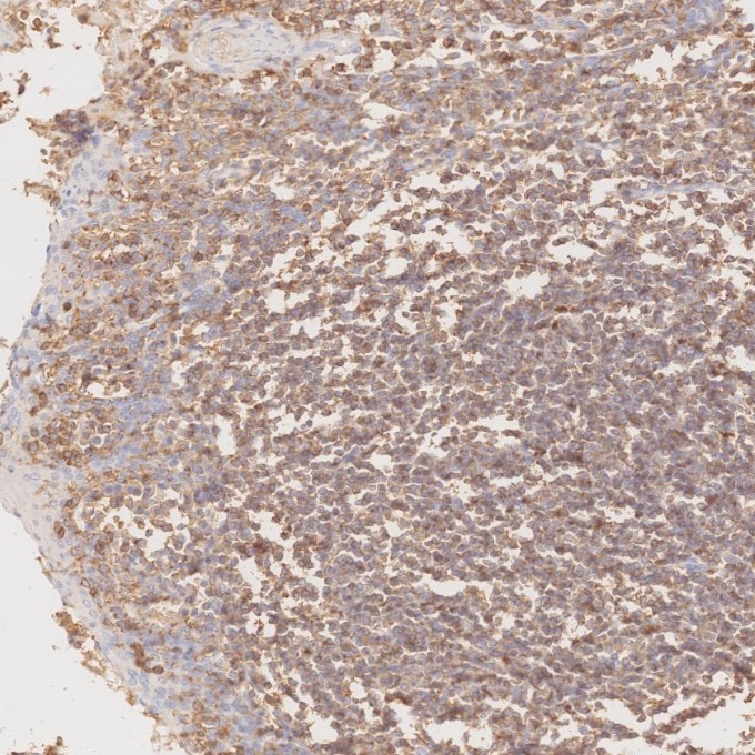 IHC staining of human tonsillitis using 80297-1-RR Immunohistochemistry (IHC) staining of human tonsillitis tissue using CD45 Recombinant monoclonal antibody (80297-1-RR)