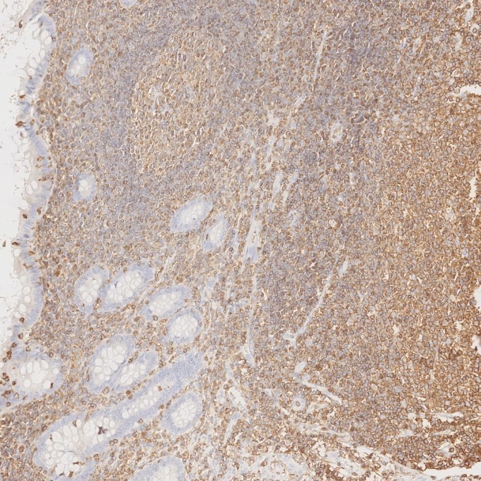 IHC staining of human appendicitis using 80297-1-RR Immunohistochemistry (IHC) staining of human appendicitis tissue using CD45 Recombinant monoclonal antibody (80297-1-RR)