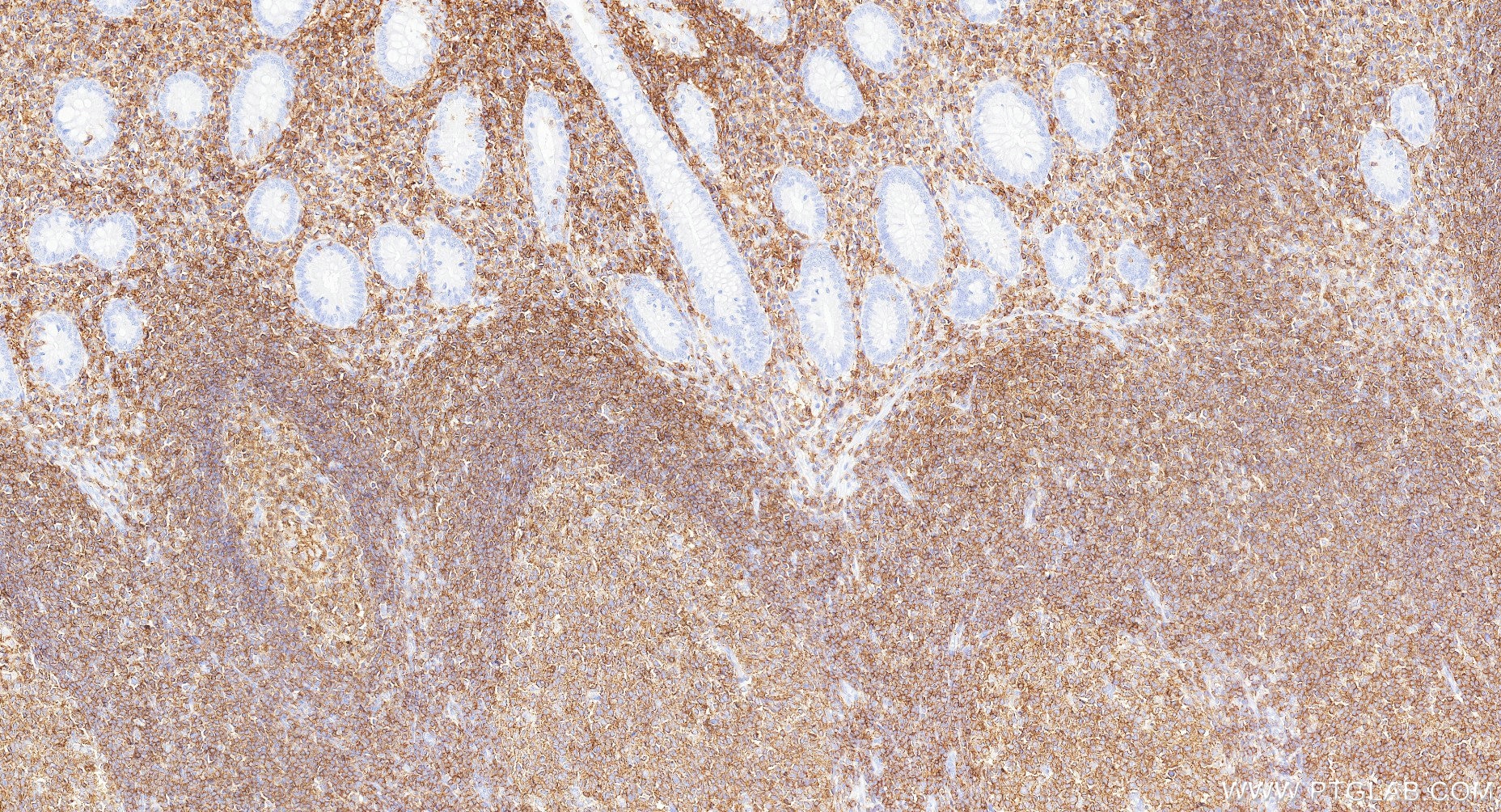 Immunohistochemistry (IHC) staining of human appendicitis tissue using CD45 Recombinant monoclonal antibody (84405-6-RR)