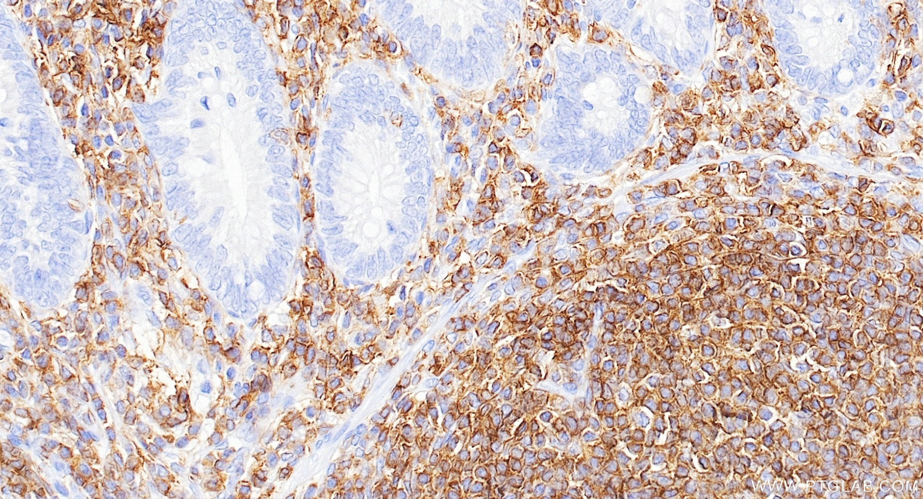 Immunohistochemistry (IHC) staining of human appendicitis tissue using CD45 Recombinant monoclonal antibody (84405-6-RR)