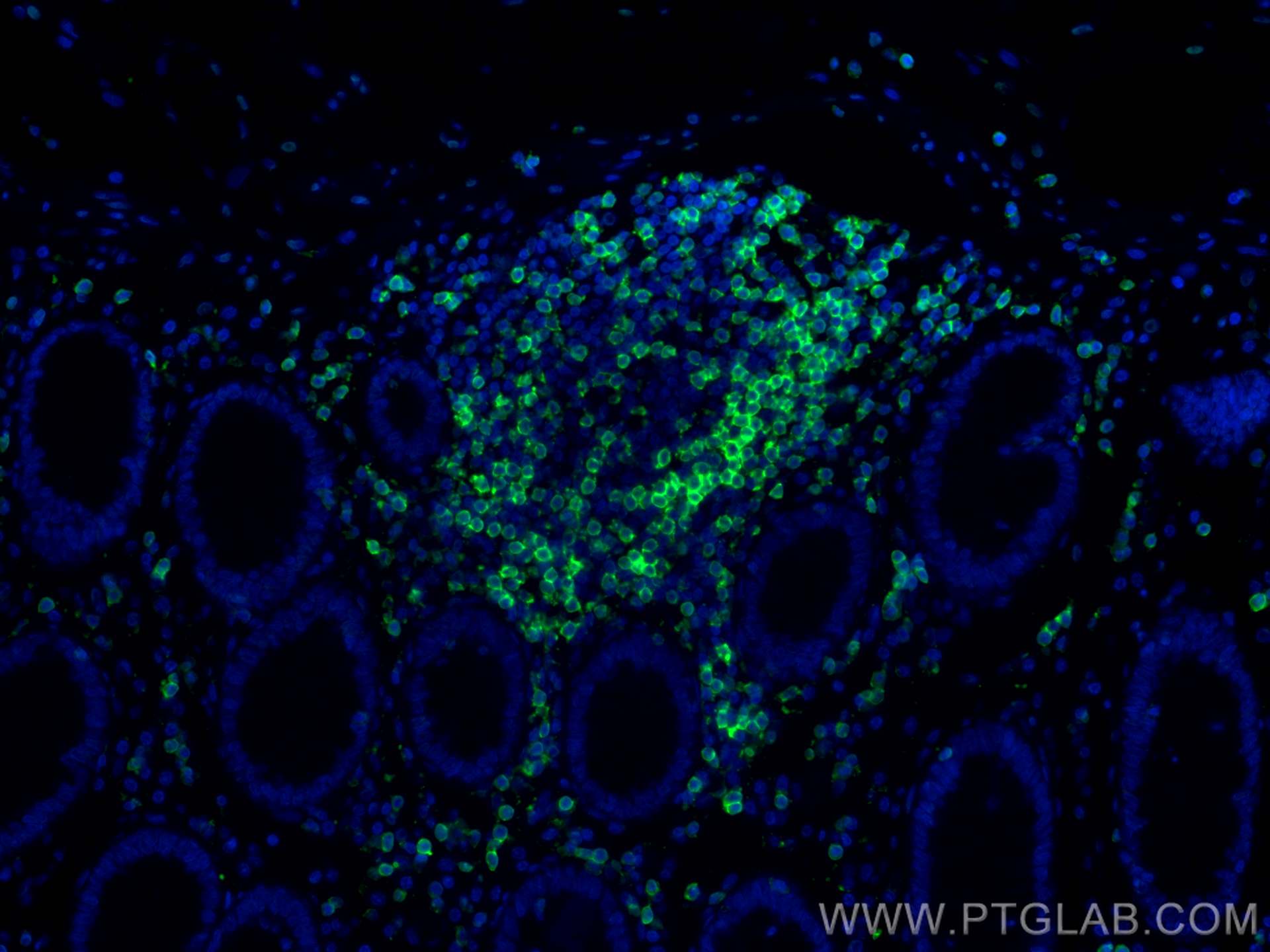 Immunofluorescence (IF) / fluorescent staining of human colon cancer tissue using Anti-Human CD45RO (UCHL1) (65150-1-Ig)