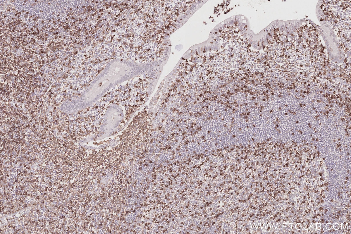 IHC staining of human appendicitis using 65150-1-Ig Immunohistochemistry (IHC) staining of human appendicitis tissue using Anti-Human CD45RO (UCHL1) (65150-1-Ig)