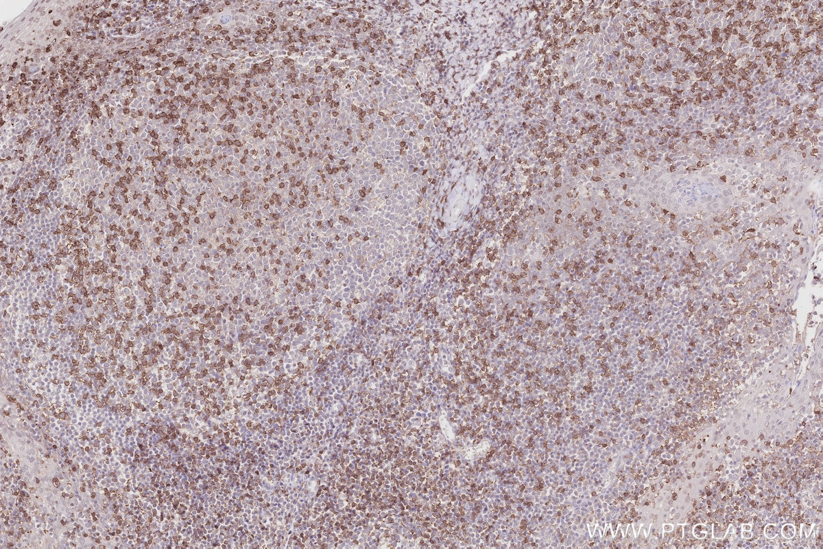 IHC staining of human tonsillitis using 65150-1-Ig Immunohistochemistry (IHC) staining of human tonsillitis tissue using Anti-Human CD45RO (UCHL1) (65150-1-Ig)